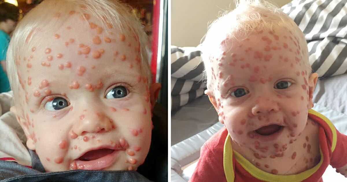 ילד עם מחלה נדירה שגורמת לנקודות 'אבעבועות רוח' לכסות את הגוף שלו, מסתבר שזו מחלה של 1 ל 100,000