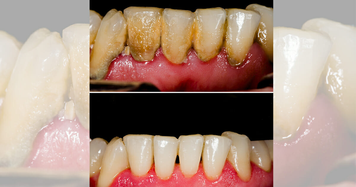 עם מרכיב אחד מהמטבח שלכם אתם יכולים לחסוך הרבה מאוד טיפולים וכסף אצל רופא השיניים