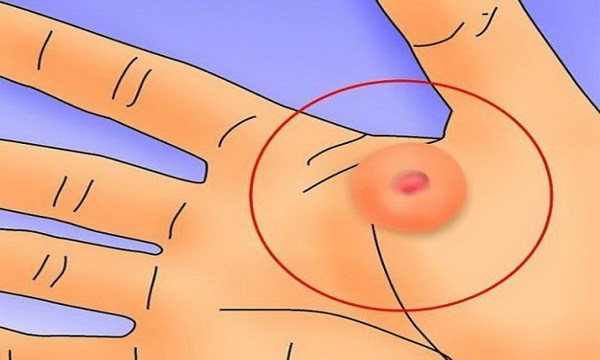 איך להיפטר משלפוחיות בצורה טבעית וקלה בעזרת דברים שיש לכם בבית?