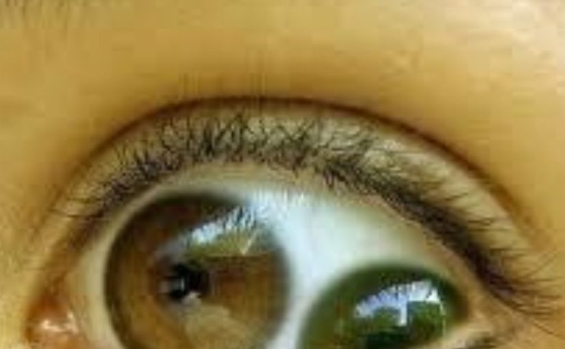 המצב הרפואי הזה כל כך נדיר, שאנשים בטוחים שהוא לא אמיתי