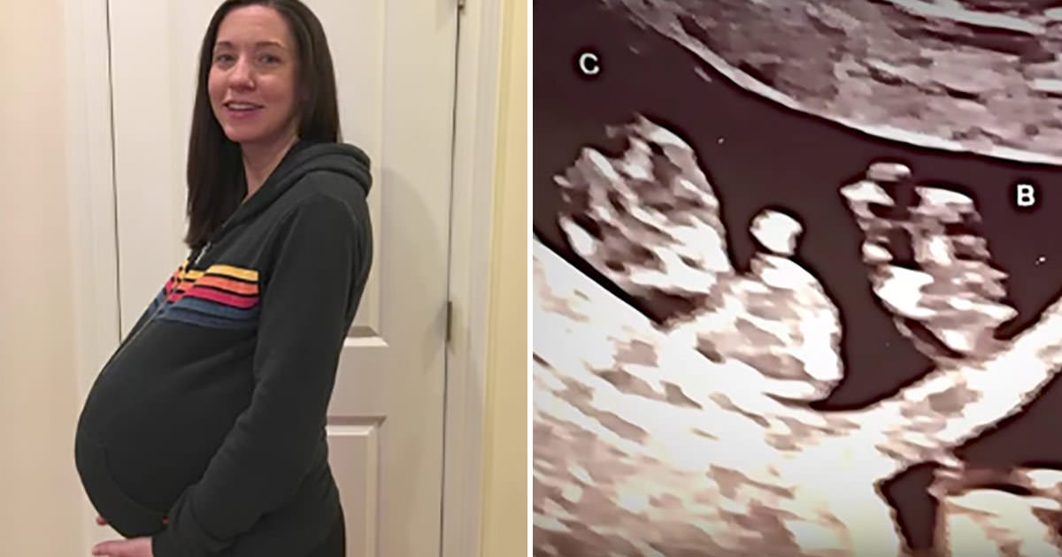 אמא הייתה בהריון עם שלישייה, אז הרופא הסתכל על האולטרסאונד ונהיה חיוור