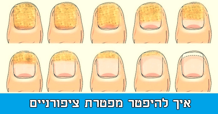 בעזרת 2 מרכיבים בלבד תוכלו להיפטר במהירות ובקלות מפטרת ציפורניים