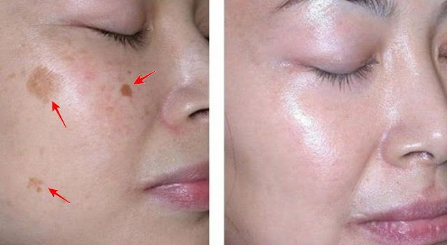 ביי ביי כתמי פיגמנטציה: השיגו עור פנים חלק ומהמם עם המסכה הטבעית הזאת