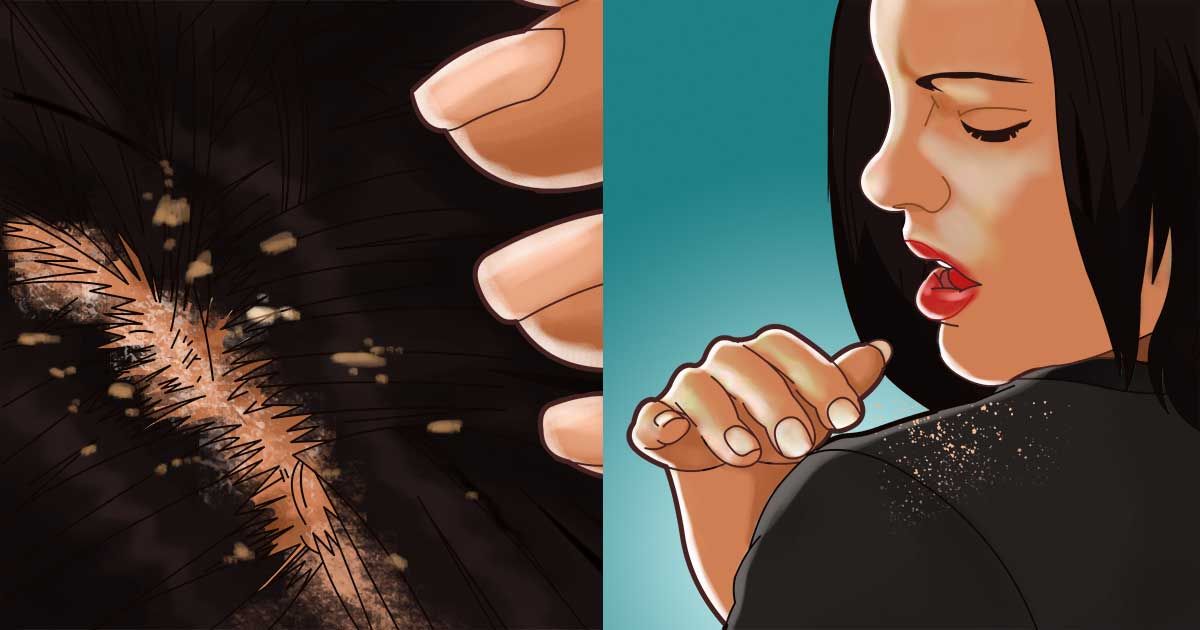 תגידו ביי ביי לקשקשים בשיער עם 3 הטיפולים הטבעיים האלה