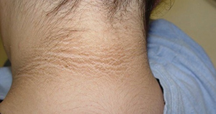 אמא הבחינה בטבעת שחורה סביב צווארה של בתה. אם אתם מבחינים בזה גם, תלכו מיד לבית החולים…