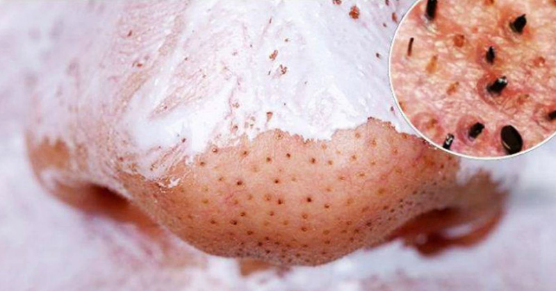 איך להשתמש בסודה לשתייה ושמן קוקוס לניקוי פנים כמו שבחיים לא היה לכן!