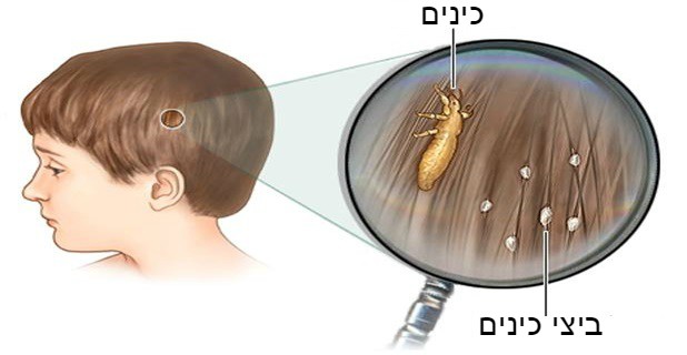 רופאים לא יגלו לכם: כך תיפטרו מכינים בשיער בקלות ובזול!