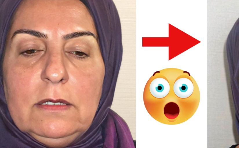 האם זו אותה אישה? תמונות לפני ואחרי שפרסם מנתח פלסטי מטורקיה השאירו אנשים בהלם