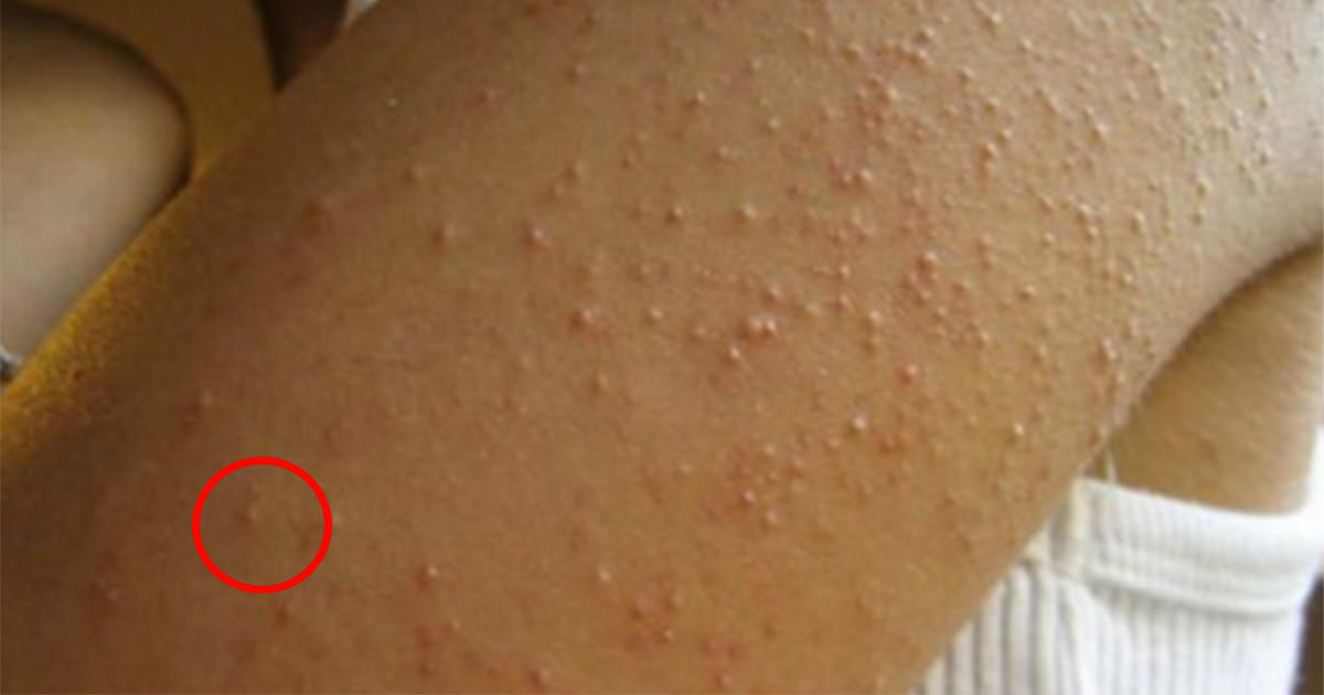 6 סימנים חבויים שמעידים שייתכן ואתם סובלים מרגישות לגלוטן