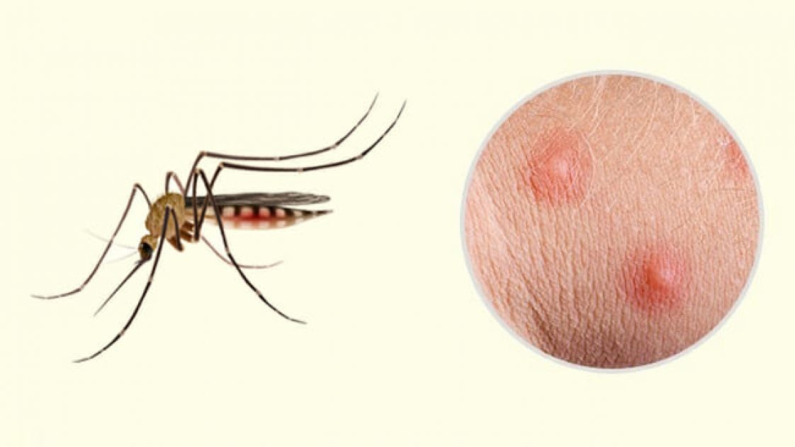 Укус малярии. Укус комар малярийный комар. Следы укуса малярийного комара. Малярийный комар укусил место укуса.